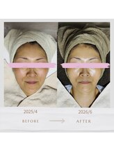 ルブラン(Le blanc)/ヒト幹細胞導入before＆after