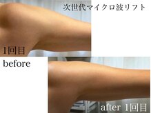サロンドール(salon doll)の雰囲気(気になるタプつき二の腕も、マイクロ波ですっきり引き締めました)
