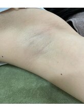 ナノハナ/鹿沼市の全身脱毛のナノハナ