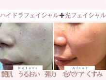 Cスキンケアクリニック 麻布店/ハイドラ＋光フェイシャル