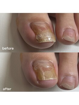 巻き爪矯正3回目(左親指)