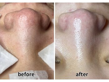 エヌエクラ(N.eclat.)/鼻の毛穴、透明感