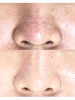 ユーエステティック(U AESTHETIC)/鼻の毛穴集中ケア