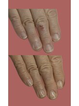 リラマジック (Rela-Magic)/ネイルトラブル　Before After