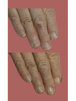 ネイルトラブル　Before After