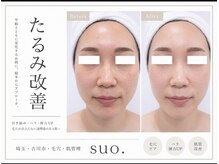 スオ(SUO.)の雰囲気(年齢とともに気になるたるみを引き締め若々しい印象へ導きます♪)