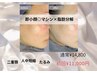 【二重顎・フェイスライン】脂肪分解×マシンで即小顔へ◎￥11,000～