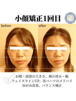 RKY/歪み改善(20代)