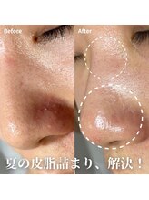 アムリリー 南草津店(AMRILY)/毛穴のつまり、引き締め