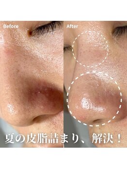 アムリリー 南草津店(AMRILY)/毛穴のつまり、引き締め