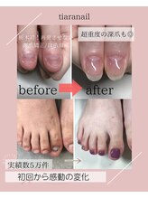 ティアラネイル(tiaranail) 栃木県初！ 深爪矯正