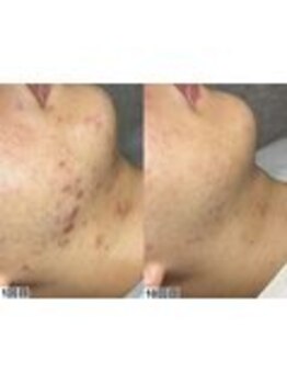 アンドミー 鹿児島中山(&me)/ハーブピーリング【ニキビケア】