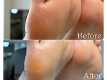 カシェット 広島店(Cachette)/30代女性☆足裏角質ケア90分