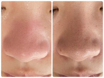 ラヴィ(Ravi)/毛穴のお悩み