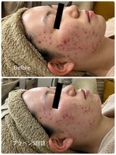 ジャスミン(Jasmin)/プラペン×幹細胞