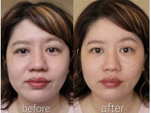 楓整骨院/美容鍼Before・After