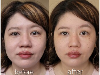 楓整骨院/美容鍼Before・After