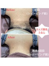 ラ フェリーチェ(La Felice)/キッズ脱毛うなじBefore After