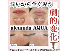 アルムダアクア 天王寺店(Aleumda AQUA)/毛穴エクストラクションプロ大阪