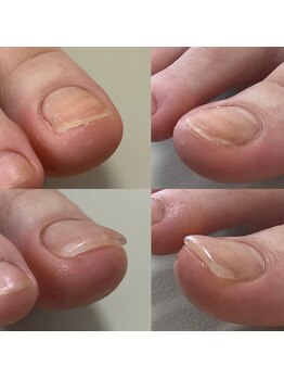 ウェルズユキ(well's yuki)/食い込んでいる爪/巻き爪補正