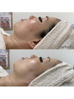 レゾン 京橋店/【ビフォーアフター】たるみ改善