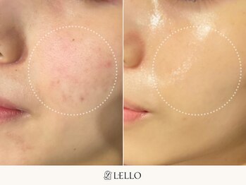 レロ 恵比寿店(LELLO)/