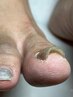 【巻き爪・姿勢ごと変える整体】歩きたくなる足へ＜整体＋爪ケア＞ →¥11,000