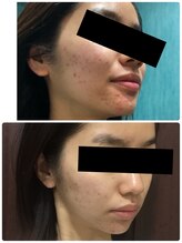 ぐりーんりぷる/金箔エステ1回の変化！