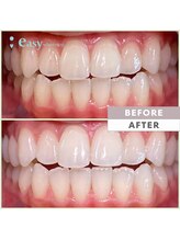 イージーホワイトニング 五反田店(easy whitening)/セルフホワイトニング症例写真