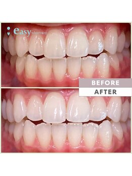イージーホワイトニング 五反田店(easy whitening)/セルフホワイトニング症例写真