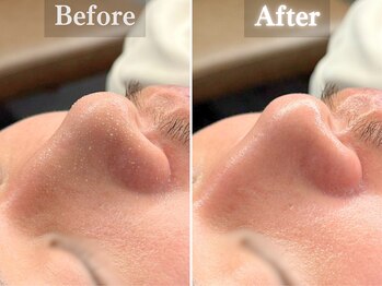 ボーンオム(Born Homme)/毛穴洗浄+美容液導入:30代男性