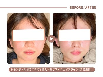 イエス マイサロン(yes My Salon)/レモンボトル施術例