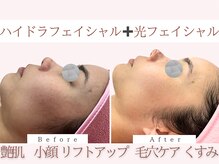 Cスキンケアクリニック 麻布店/ハイドラ＋光フェイシャル
