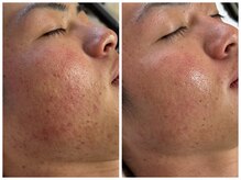 フェリス(FELIZ)/ニキビの改善