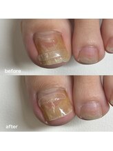 リリ(lili)/巻き爪矯正3回目（左親指）