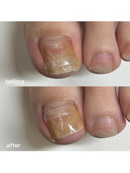 巻き爪矯正3回目（左親指）