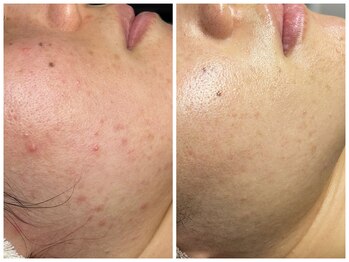 プレナ(PLENA)/本気ニキビケア