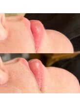 エミュ(emu)/waxzで白く光る産毛も除去！