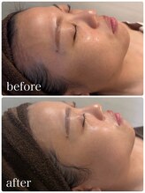 ブリス(BLiSS)/水素クレンジング＋美容液導入