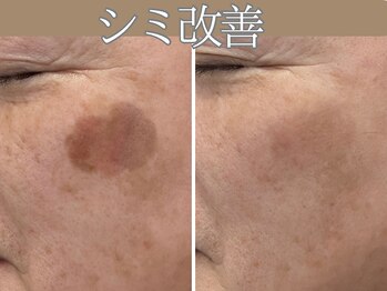 ハウオリ(HAUOLI)/シミ集中改善50分