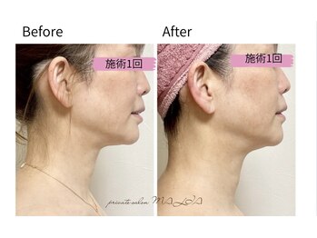 マリア(MALIA)/1回で即実感！レッドショット