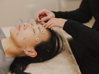 フュー(few.)の写真/施術後の変化に感動！美容鍼でむくみを改善し、スッキリ憧れのキュッと引き締まったお肌＆小顏に♪