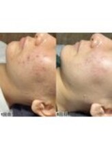 アンドミー 鹿児島中山(&me)/ハーブピーリング【ニキビケア】