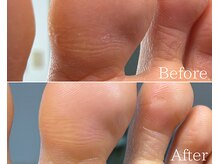 カシェット 広島店(Cachette)/30代女性☆足裏角質ケア90分