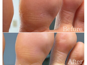 カシェット 広島店(Cachette)/30代女性☆足裏角質ケア90分