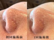 サロンキャン(Salon.CAN)/毛穴が綺麗になると肌つやUP