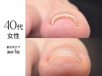 巻き爪と剥離が同時進行？！(1)