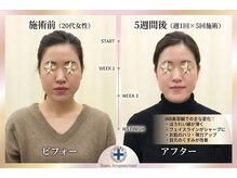井原鍼灸整骨院/IAB美容鍼