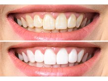 ミオ(mio)/ホワイトニング初回1980円♪