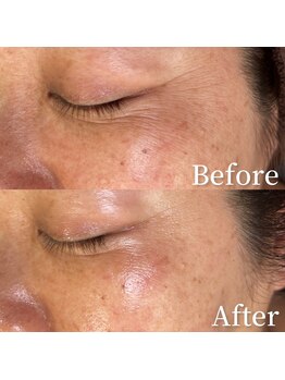 ユカリス(Yu.charis)/ハーブピーリング before→after